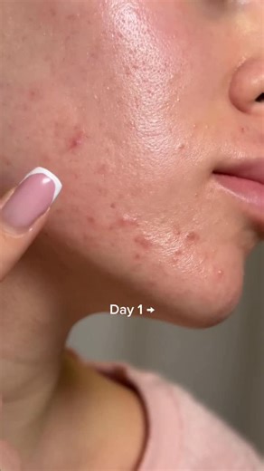 Tea-trica B5 Cream – Acne care made gentle. Target breakouts, calm irritation, and strengthen your skin barrier with Centella & Tea Tree. #acne #acneskincare #acnetips #acnecare #hormonalacne @skin1004official | Julia Tsao