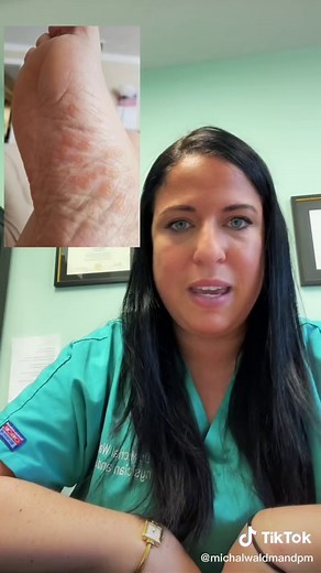 Foot Fungus Relief: How to Treat Itchy Blisters Between Toes