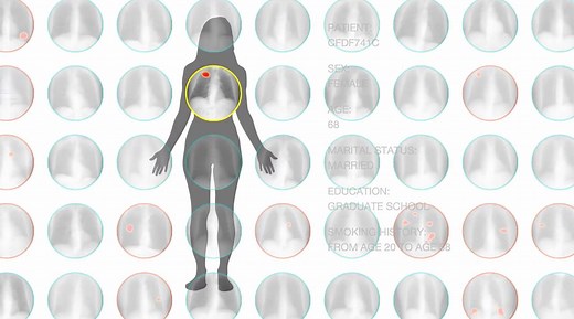 How artificial intelligence could make cancer diagnoses much more accurate: This is what Enlitic's technology can do. Full video: http://cnnmon.ie/27SBhAE w/ Rachel Crane | CNN Business