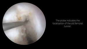 ACL Revision Reconstruction (2 stages)