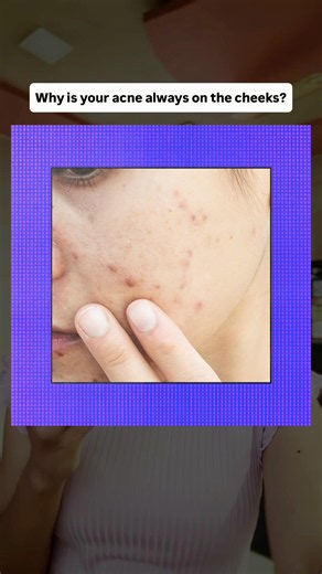 Frequent Acne on cheeks? Watch this! #acneskin #bams #ayurveda