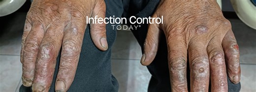 Leprosy Today: What Infection Preventionists Still Need to Know | Infection Control Today