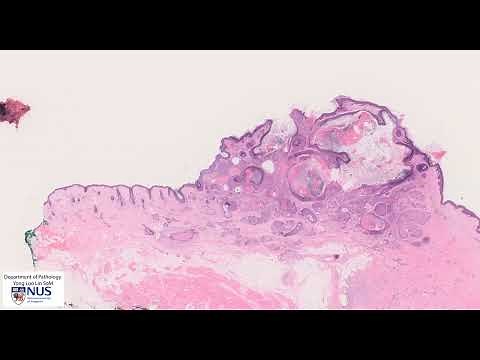 Skin - Squamous cell carcinoma Microscopy - Talking slide