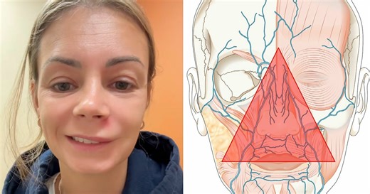 Mom Ends Up in Urgent Care After Popping Pimple In The “Triangle Of Death”