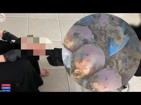 Extreme Jigger Condition – Deep Tissue Complications Explained!#DG456