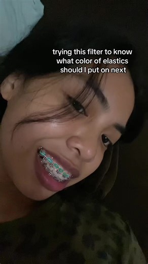 Colorful Braces Filters for Trendy Looks