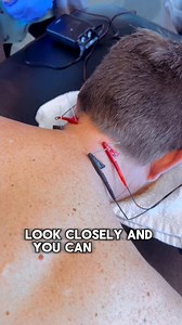 ✅ “Stubborn knots? Chronic pain? Dry needling with e-stim can help break the cycle and get you moving pain-free! 💥 #PainFreeLiving #BioMechanicPT #healthcare #physicaltherapy | BioMechanic Physical Therapy
