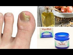 ✅ Καταπολεμήστε την ονυχομυκητίαση με τρία φυσικά συστατικά