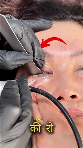 Eyeball Tattoo Removal: How It’s Safely Done #shorts #laser #tattoo