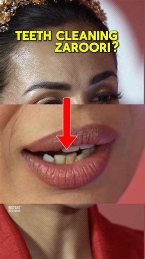 Malaika Arora Teeth Problem 😱 | Lower Teeth Mein Yellow Calculus | Dental Awareness Video #teeth