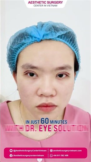 BEFORE & AFTER EYELID SURGERY – TRANSFORM YOUR LOOK IN JUST 1 HOUR