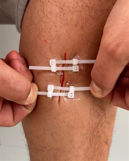 1.9M views · 2.8K reactions | Easy first aid hacks | The Beautiful Game | Facebook