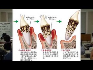 歯周病治療｜梅田クローバー歯科クリニック－大阪駅前第３ビルの歯医者－