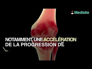 Les injections de corticoïdes dans le traitement de l'arthrose sont plus nuisible que prévu !