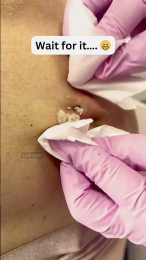 Large Blackheads Extraction Big Cystic Acne Blackheads&Whiteheads Removal Pimple Popping #1085 2026