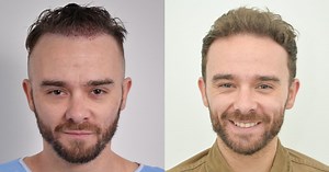 Jack P Shepherd shows off second hair transplant after his rapid hair loss