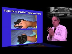Burn treatment - chapter 3 of 4 - initial management • Video • MEDtube.net