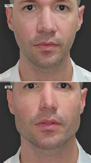 Jawline Filler in Dubai | Jawline Filler Treatment Results #shortvideo