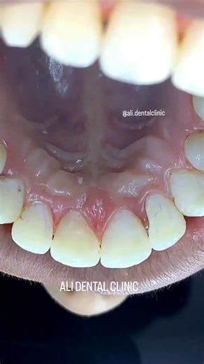 Ali Dental Clinic on Instagram: "Placing Fixed Retainer for Upper Teeth"