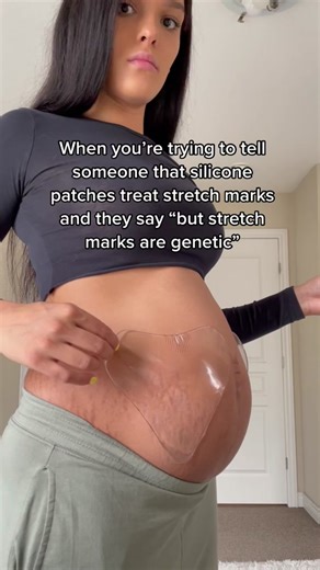 Nvm 🤨 genetics play a role but silicone patches are your best defense against stretch marks and loose skin. How to fade stretch marks. #fadestretchmarks #stretchmarkremedy #stretchmarkremoval