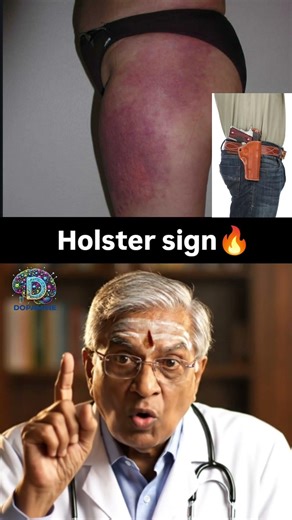 Holster Sign| Best app for NEET PG Preparation |Dopamine|