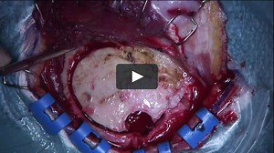 Subtemporal Approach