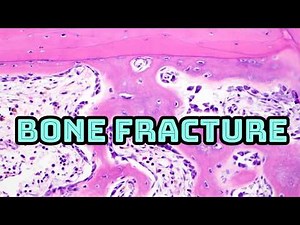 Bone fracture healing under microscope (spine fracture osteoporosis lamellar & woven bone pathology)