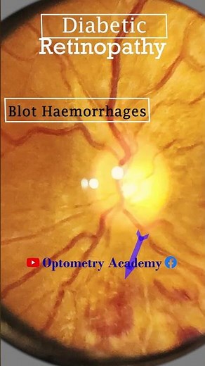 Blot haemorrhages | Flame shaped haemorrhage | retinopathy | Fundus Photography | Short Video 438