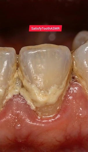 Insane Yellow Plaque Removal 😱 Satisfying Teeth Cleaning |#dentist #statisfying #asmr