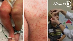 UK minister ‘worried’ after children die of ‘new disease’ potentially linked to virus