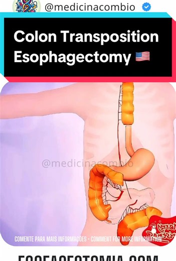 Understanding Colon Transposition Esophagectomy Procedure