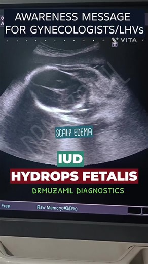 🟢 Awareness message for gynecologists/LHVs 🔴 #drmuzamildiagnostics #clearscansconfidentdiagnosis #ultrasound #gynaecologist