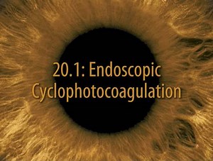 Surgical Techniques in Ophthalmology Series: Glaucoma Surgery 20. Endoscopic cyclophotocoagulation Shan C. Lin #Glaucoma_Surgery #Glaucoma | Piece of ophthalmology