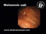 Melanosis Coli • Video • MEDtube.net