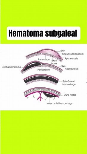 Subgaleal hematoma #subgalealhematoma #medicine #headinjury #health