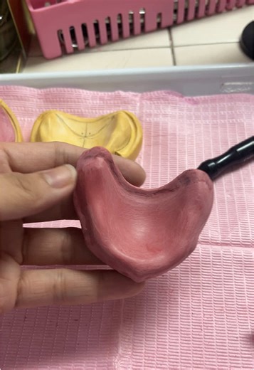 Complete Denture Adaptation Using Shellac Techniques