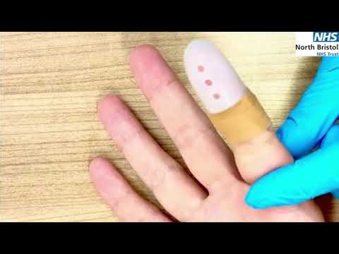 Mallet Finger Injury – Splint Care and Education for Patients