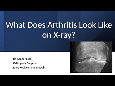 What Does Arthritis Look Like on X-ray
