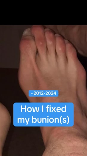 Vance Peiffer on Instagram: "How to fix bunions, wearing toe spacers and barefoot shoes helped me a lot too. Surgery scar isn’t from bunion correction, it’s from screws to flatten the hammer toe #goata #nba #nfl #bunions #toes"