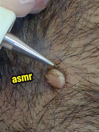 E aí, meus irmãos! 🔥✨ Olha essa cauterização de verruga com jato de plasma 👀⚡ Procedimento rápido, preciso e super eficaz! O jato de plasma atua diretamente na lesão, promovendo a remoção de forma segura e com ótima cicatrização. Resultado: pele mais uniforme e autoestima lá em cima! 🙌✨ Aqui é procedimento com responsabilidade, técnica e resultado REAL! Se você curte ver transformação de verdade: ❤️ Curte esse vídeo 💬 Comenta o que achou 👥 Segue o perfil pra mais conteúdos incríveis de esté