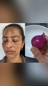 Onion Extract Erases all the Spots Instantly! 100-Year-Old Anti-Aging Secret! #glowingskin #antiaging #darkspots #skincare | Health Care Zone