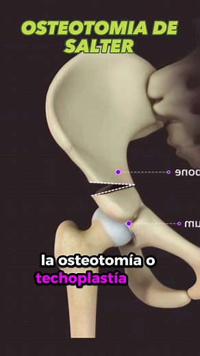 Osteotomía tipo SALTER en niños deambuladores: Cirugía y Tratamiento