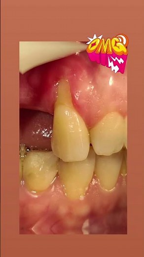 Root coverage surgery