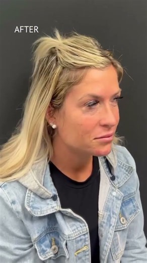Complex Revision Rhinoplasty Before & After | Dr. Robert Morin
