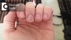 2.3K views · 16 reactions | White spots on toe nails or finger nails...
