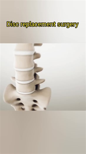 Understanding Disc Replacement Surgery Procedures