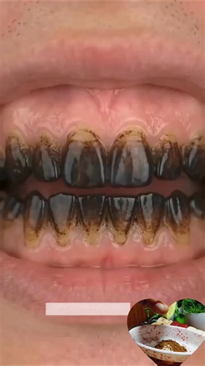 Best Teeth Whitening Pack 100% Result #shorts #teethwhitening #beautytips #homeremedies