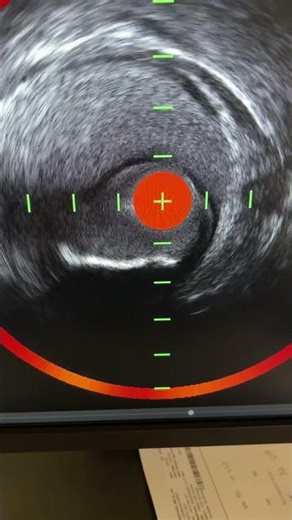 Intramural hematoma on NIRS IVUS - partially compressive