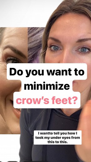 21K views · 19 reactions | Let’s talk CROW’S FEET. First, don’t be...