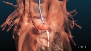 TAVI Transcatheter Aortic Valve Implantation - Medical Animation by Geometric